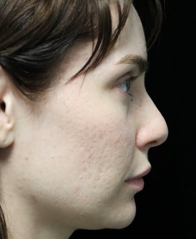 Beverly Hills Rhinoplasty Before & After Gallery - Patient 111829 - Image 1 Dr. Deepak Raj Dugar