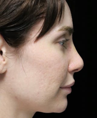 Beverly Hills Rhinoplasty Before & After Gallery - Patient 111829 - Image 2 Dr. Deepak Raj Dugar