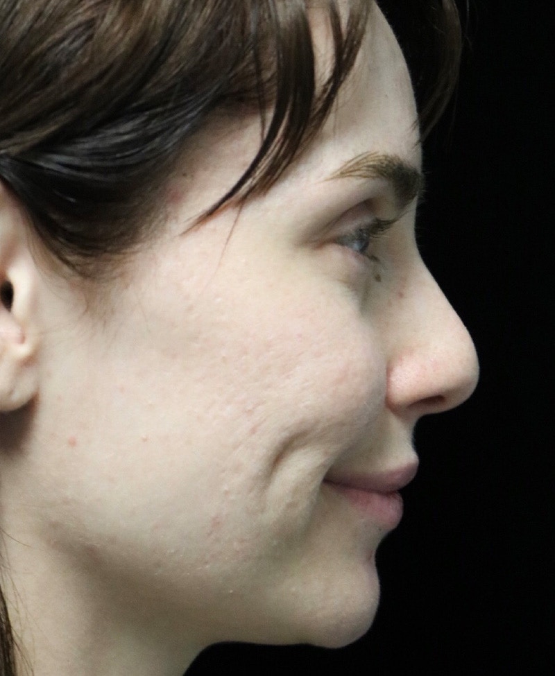 Beverly Hills Rhinoplasty Before & After Gallery - Patient 111829 - Image 3 Dr. Deepak Raj Dugar