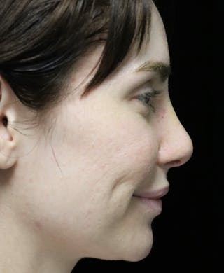 Beverly Hills Rhinoplasty Before & After Gallery - Patient 111829 - Image 4 Dr. Deepak Raj Dugar