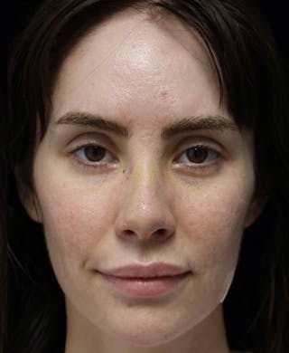 Beverly Hills Rhinoplasty Before & After Gallery - Patient 111829 - Image 6 Dr. Deepak Raj Dugar