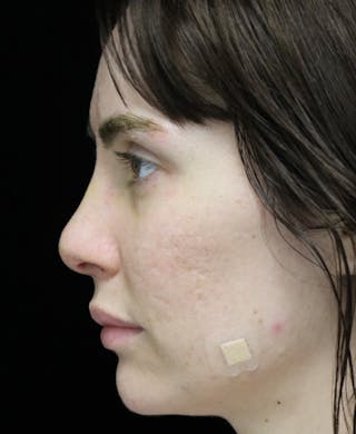 Beverly Hills Rhinoplasty Before & After Gallery - Patient 111829 - Image 12 Dr. Deepak Raj Dugar