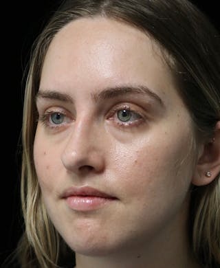 Beverly Hills Rhinoplasty Before & After Gallery - Patient 401508 - Image 10 Dr. Deepak Raj Dugar