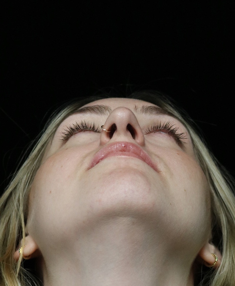 Beverly Hills Rhinoplasty Before & After Gallery - Patient 401508 - Image 12 Dr. Deepak Raj Dugar