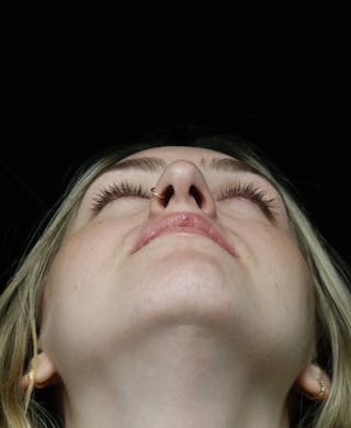 Beverly Hills Rhinoplasty Before & After Gallery - Patient 401508 - Image 12 Dr. Deepak Raj Dugar