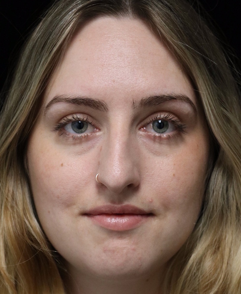 Beverly Hills Rhinoplasty Before & After Gallery - Patient 401508 - Image 5 Dr. Deepak Raj Dugar
