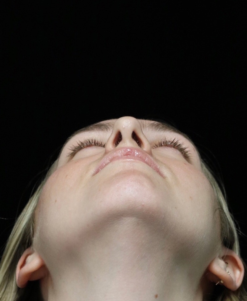 Beverly Hills Rhinoplasty Before & After Gallery - Patient 401508 - Image 11 Dr. Deepak Raj Dugar