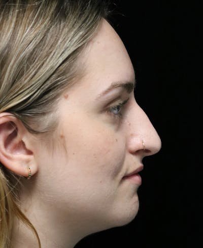 Beverly Hills Rhinoplasty Before & After Gallery - Patient 401508 - Image 1 Dr. Deepak Raj Dugar