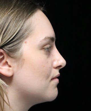 Beverly Hills Rhinoplasty Before & After Gallery - Patient 401508 - Image 2 Dr. Deepak Raj Dugar
