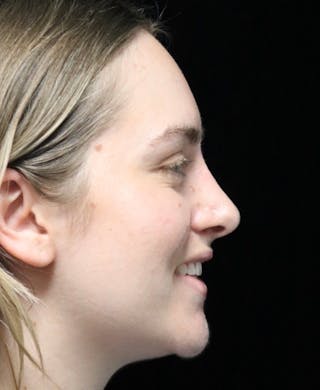 Beverly Hills Rhinoplasty Before & After Gallery - Patient 401508 - Image 4 Dr. Deepak Raj Dugar