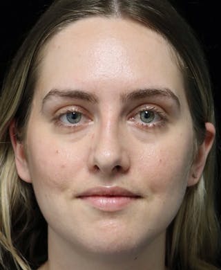 Beverly Hills Rhinoplasty Before & After Gallery - Patient 401508 - Image 6 Dr. Deepak Raj Dugar