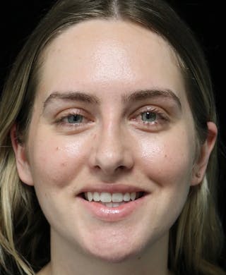 Beverly Hills Rhinoplasty Before & After Gallery - Patient 401508 - Image 8 Dr. Deepak Raj Dugar