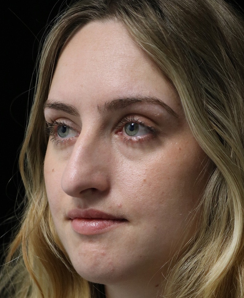 Beverly Hills Rhinoplasty Before & After Gallery - Patient 401508 - Image 9 Dr. Deepak Raj Dugar