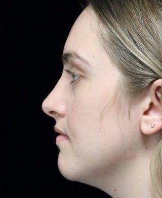 Beverly Hills Rhinoplasty Before & After Gallery - Patient 401508 - Image 14 Dr. Deepak Raj Dugar