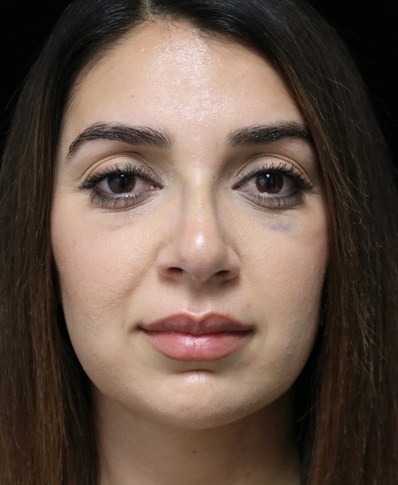 Beverly Hills Rhinoplasty Before & After Gallery - Patient 294599 - Image 6 Dr. Deepak Raj Dugar