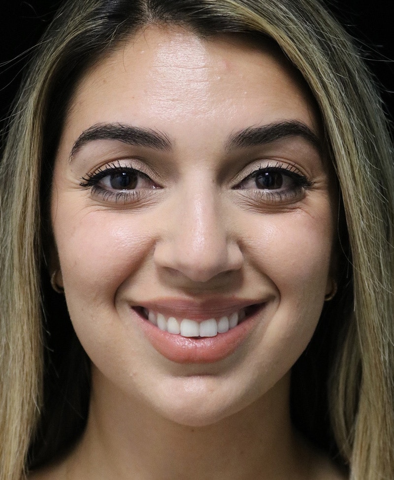 Beverly Hills Rhinoplasty Before & After Gallery - Patient 294599 - Image 7 Dr. Deepak Raj Dugar