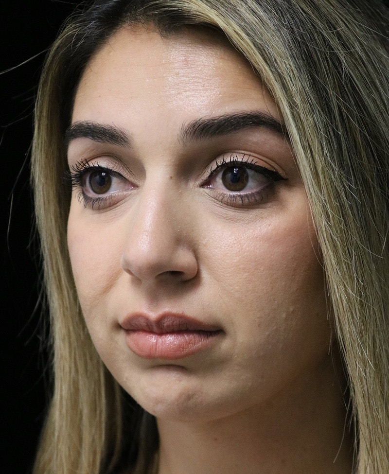 Beverly Hills Rhinoplasty Before & After Gallery - Patient 294599 - Image 9 Dr. Deepak Raj Dugar