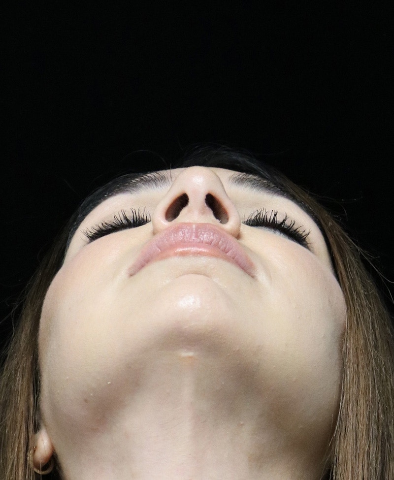 Beverly Hills Rhinoplasty Before & After Gallery - Patient 294599 - Image 13 Dr. Deepak Raj Dugar
