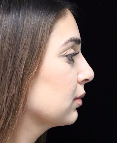 Beverly Hills Rhinoplasty Before & After Gallery - Patient 294599 - Image 2 Dr. Deepak Raj Dugar