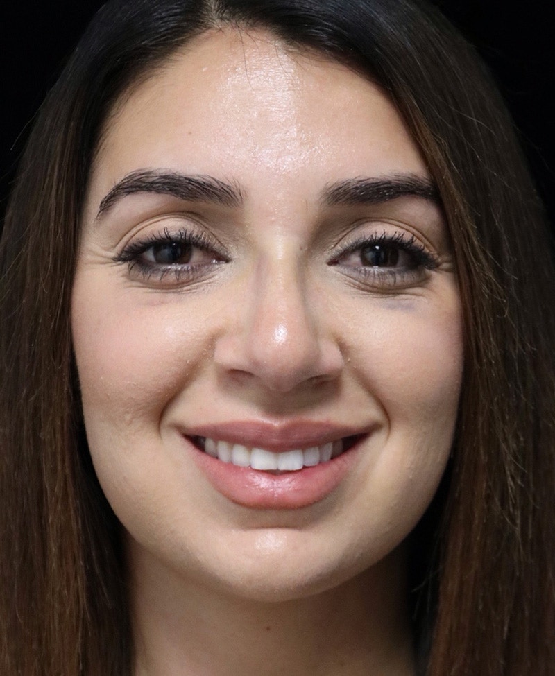 Beverly Hills Rhinoplasty Before & After Gallery - Patient 294599 - Image 8 Dr. Deepak Raj Dugar