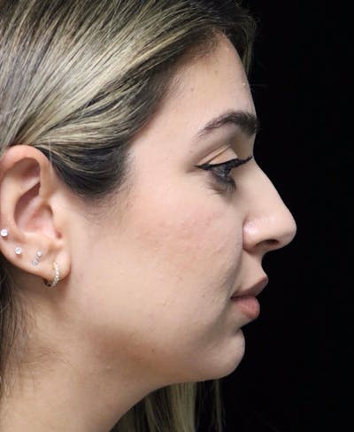 Beverly Hills Rhinoplasty Before & After Gallery - Patient 294599 - Image 1 Dr. Deepak Raj Dugar