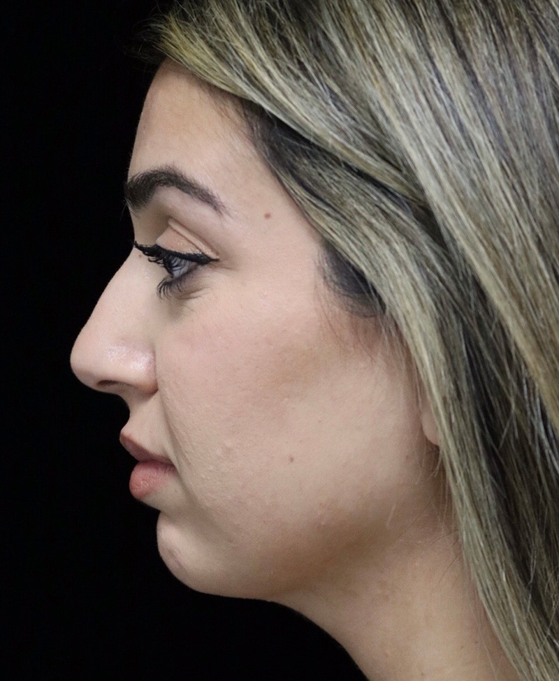 Beverly Hills Rhinoplasty Before & After Gallery - Patient 294599 - Image 11 Dr. Deepak Raj Dugar