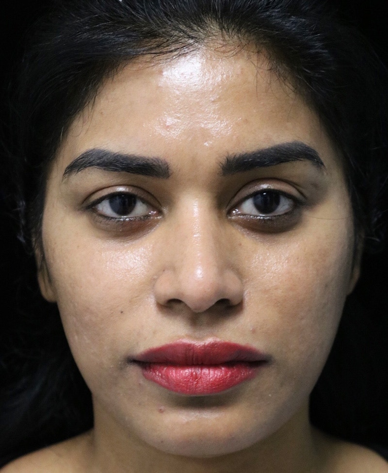 Beverly Hills Rhinoplasty Before & After Gallery - Patient 492793 - Image 3 Dr. Deepak Raj Dugar