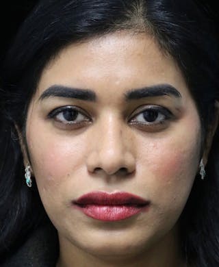 Beverly Hills Rhinoplasty Before & After Gallery - Patient 492793 - Image 4 Dr. Deepak Raj Dugar