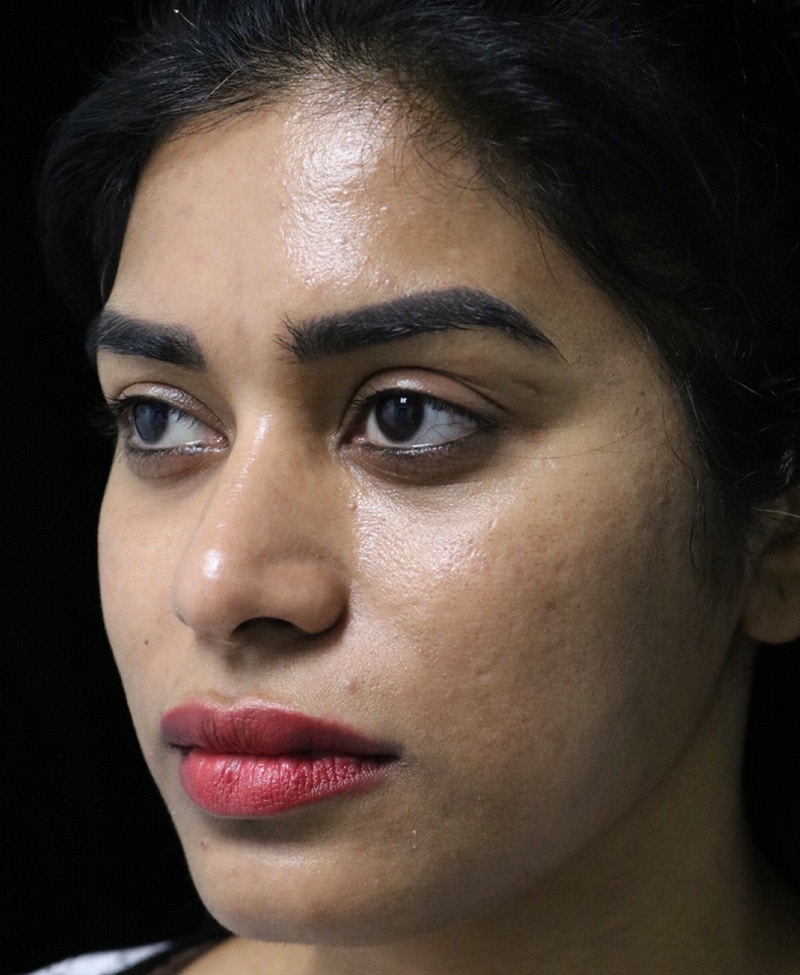 Beverly Hills Rhinoplasty Before & After Gallery - Patient 492793 - Image 7 Dr. Deepak Raj Dugar
