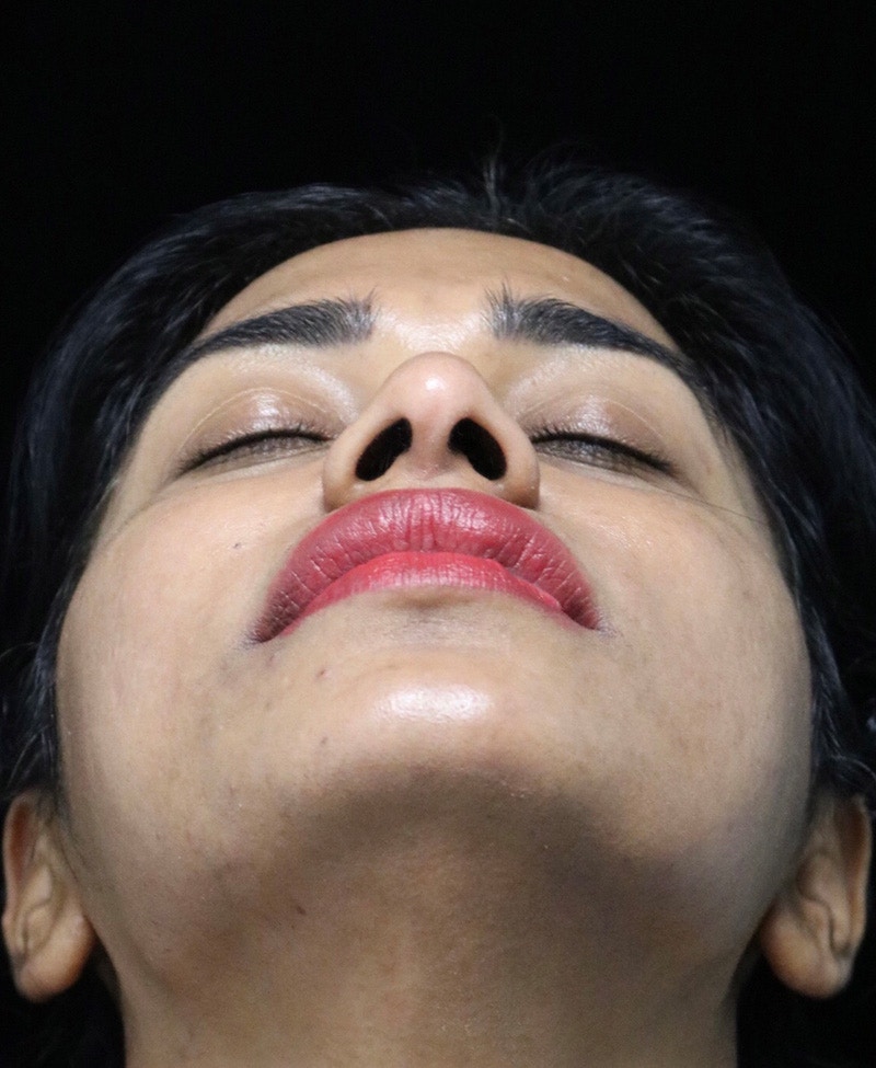 Beverly Hills Rhinoplasty Before & After Gallery - Patient 492793 - Image 9 Dr. Deepak Raj Dugar