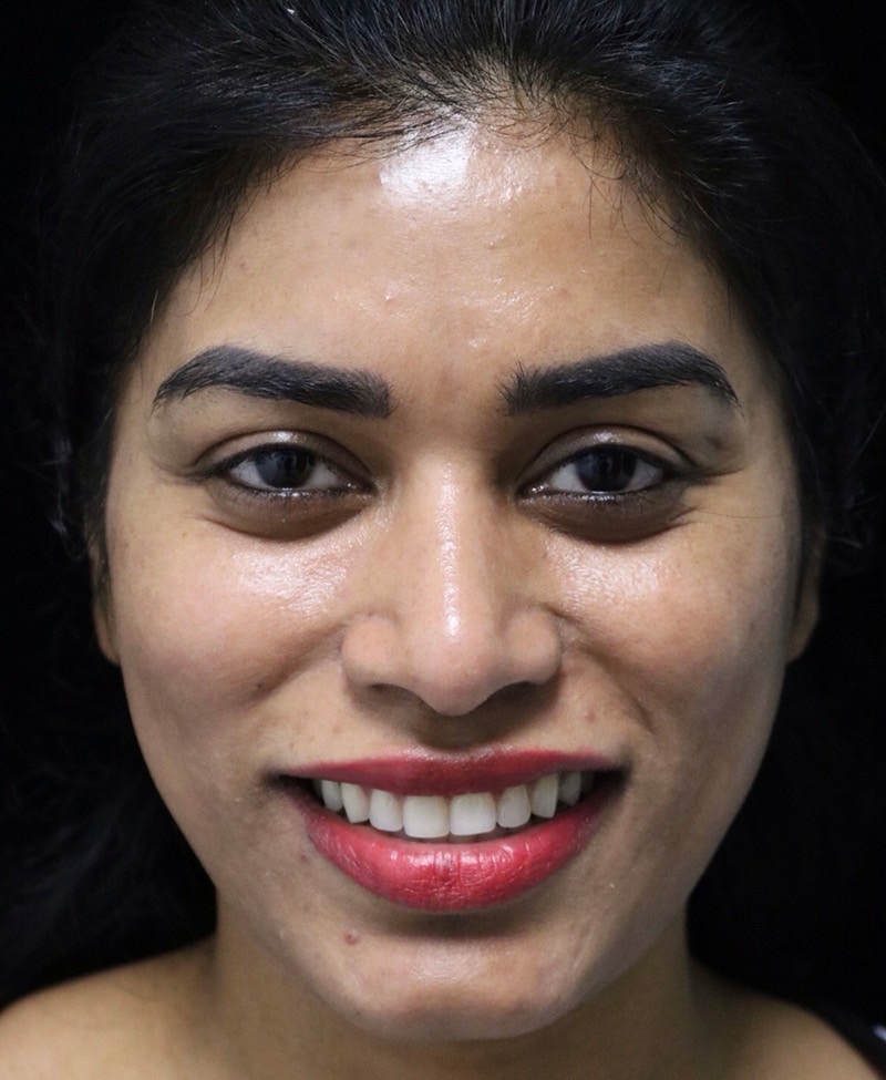 Beverly Hills Rhinoplasty Before & After Gallery - Patient 492793 - Image 5 Dr. Deepak Raj Dugar