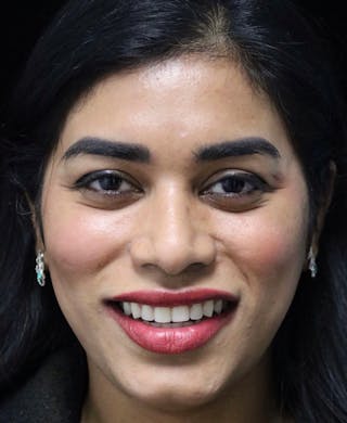 Beverly Hills Rhinoplasty Before & After Gallery - Patient 492793 - Image 6 Dr. Deepak Raj Dugar