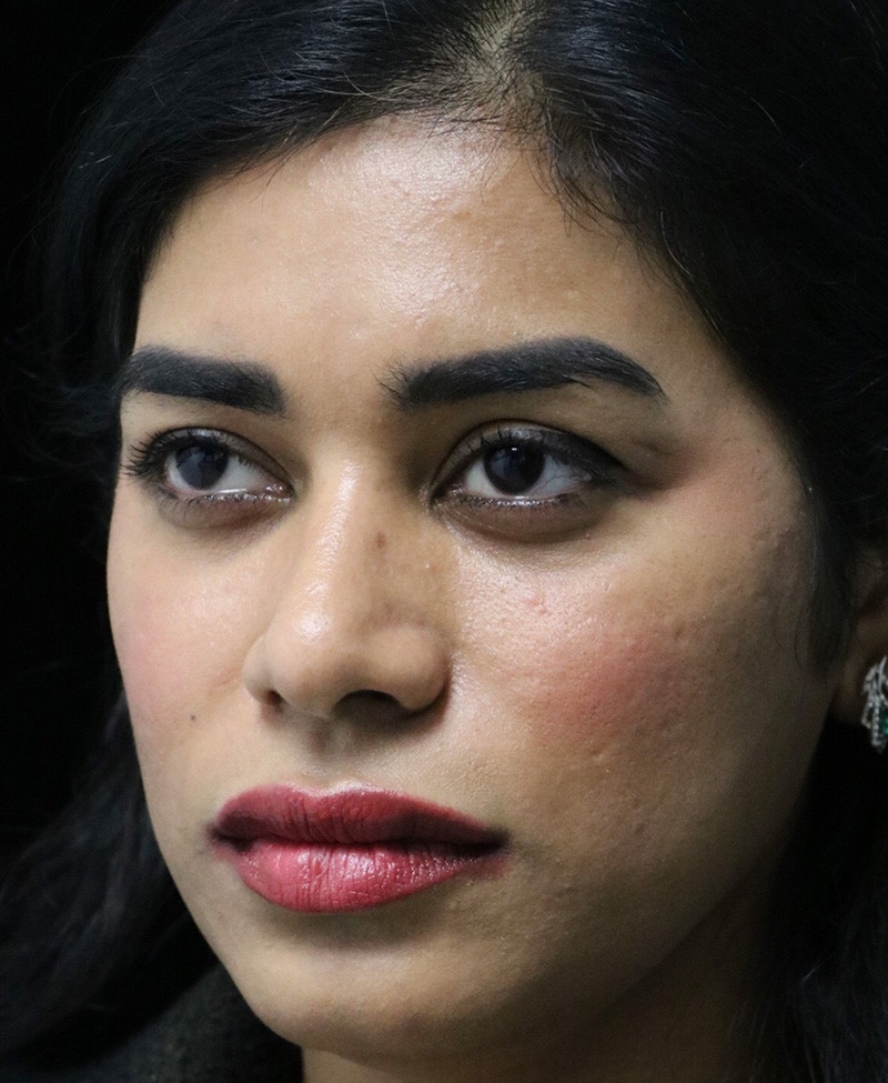 Beverly Hills Rhinoplasty Before & After Gallery - Patient 492793 - Image 8 Dr. Deepak Raj Dugar