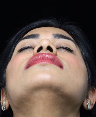 Beverly Hills Rhinoplasty Before & After Gallery - Patient 492793 - Image 10 Dr. Deepak Raj Dugar