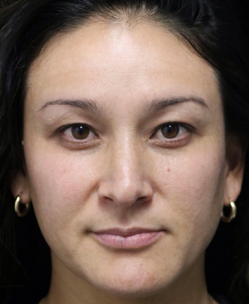 Beverly Hills Rhinoplasty Before & After Gallery - Patient 170480 - Image 5 Dr. Deepak Raj Dugar