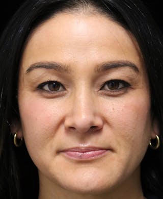 Beverly Hills Rhinoplasty Before & After Gallery - Patient 170480 - Image 6 Dr. Deepak Raj Dugar