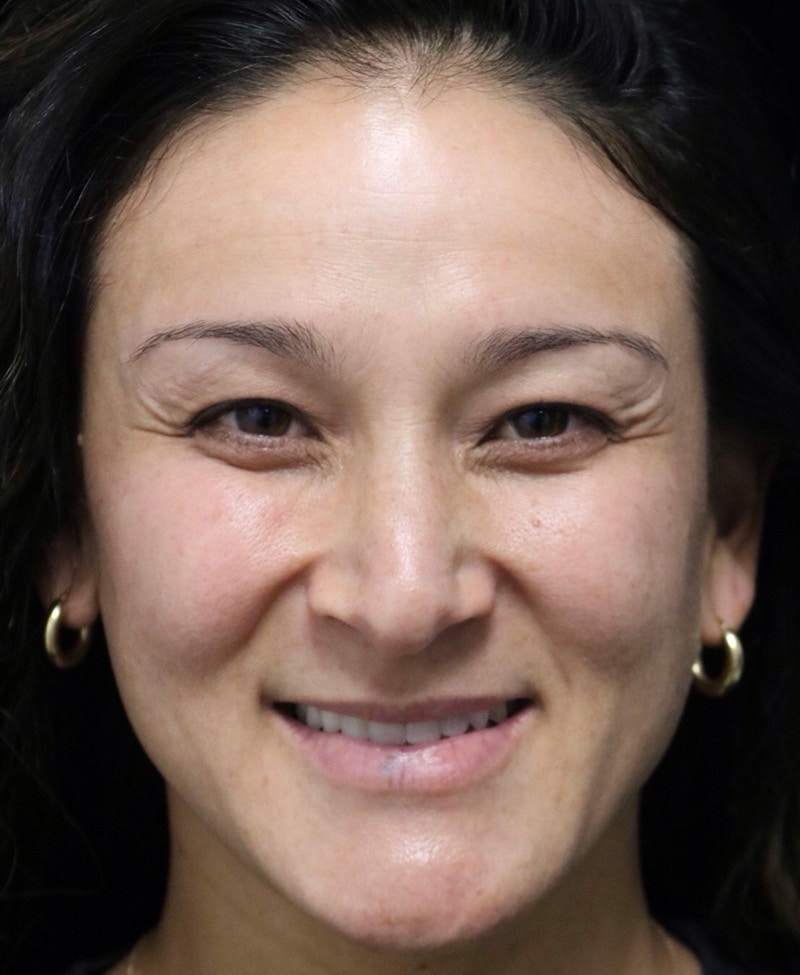 Beverly Hills Rhinoplasty Before & After Gallery - Patient 170480 - Image 7 Dr. Deepak Raj Dugar