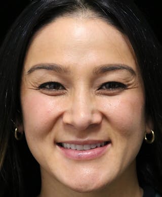 Beverly Hills Rhinoplasty Before & After Gallery - Patient 170480 - Image 8 Dr. Deepak Raj Dugar