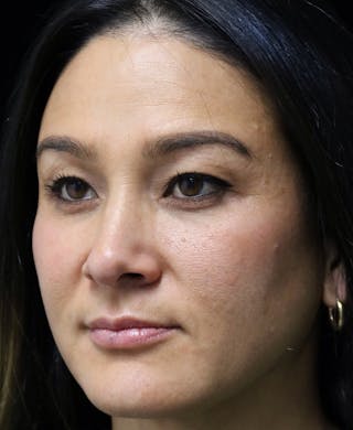 Beverly Hills Rhinoplasty Before & After Gallery - Patient 170480 - Image 10 Dr. Deepak Raj Dugar