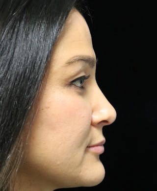 Beverly Hills Rhinoplasty Before & After Gallery - Patient 170480 - Image 2 Dr. Deepak Raj Dugar