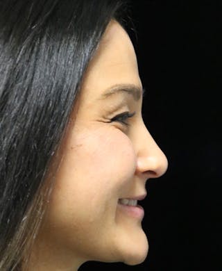 Beverly Hills Rhinoplasty Before & After Gallery - Patient 170480 - Image 4 Dr. Deepak Raj Dugar