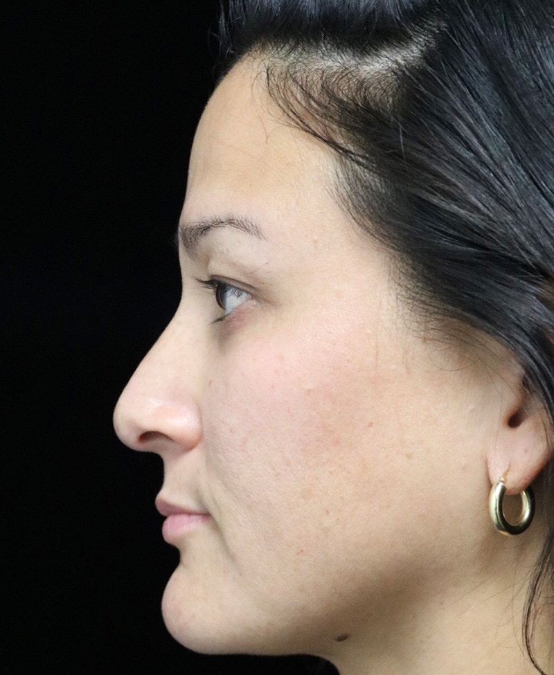 Beverly Hills Rhinoplasty Before & After Gallery - Patient 170480 - Image 11 Dr. Deepak Raj Dugar