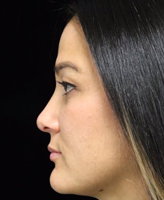Beverly Hills Rhinoplasty Before & After Gallery - Patient 170480 - Image 12 Dr. Deepak Raj Dugar