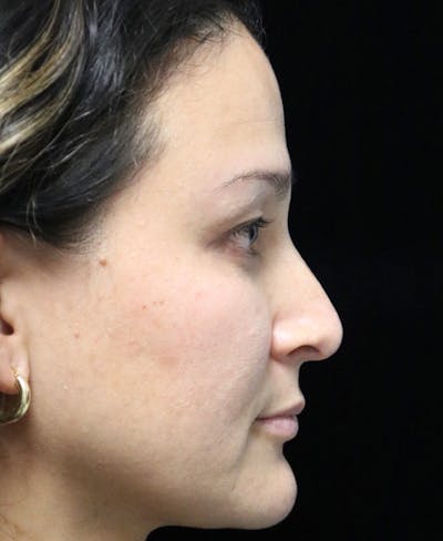Beverly Hills Rhinoplasty Before & After Gallery - Patient 170480 - Image 1 Dr. Deepak Raj Dugar