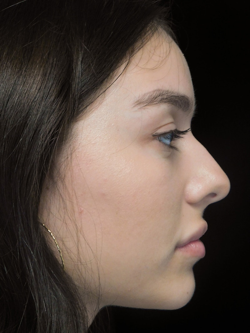 Beverly Hills Rhinoplasty Before & After Gallery - Patient 377700 - Image 1 Dr. Deepak Raj Dugar