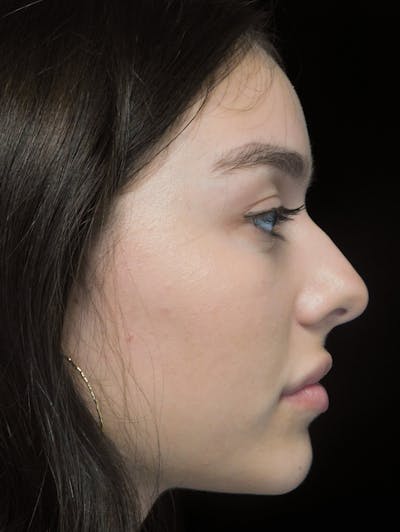 Beverly Hills Rhinoplasty Before & After Gallery - Patient 377700 - Image 1 Dr. Deepak Raj Dugar