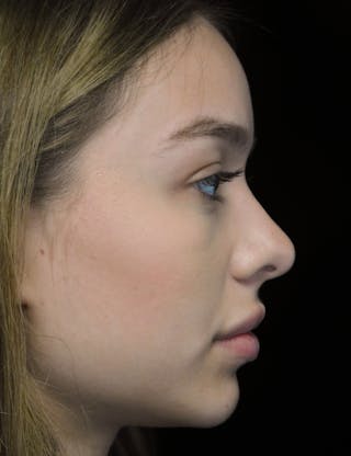 Beverly Hills Rhinoplasty Before & After Gallery - Patient 377700 - Image 2 Dr. Deepak Raj Dugar