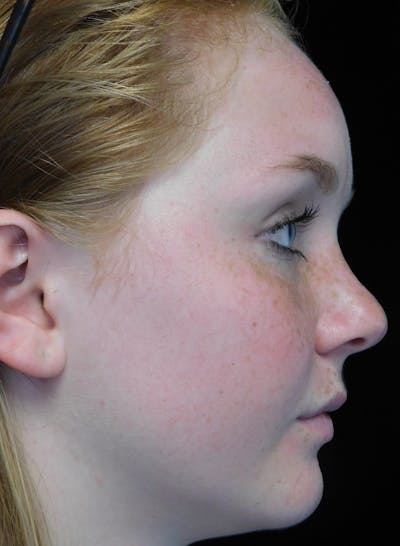 Beverly Hills Rhinoplasty Before & After Gallery - Patient 504445 - Image 1 Dr. Deepak Raj Dugar