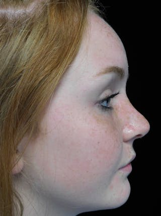 Beverly Hills Rhinoplasty Before & After Gallery - Patient 504445 - Image 2 Dr. Deepak Raj Dugar