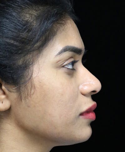 Beverly Hills Rhinoplasty Before & After Gallery - Patient 492793 - Image 1 Dr. Deepak Raj Dugar